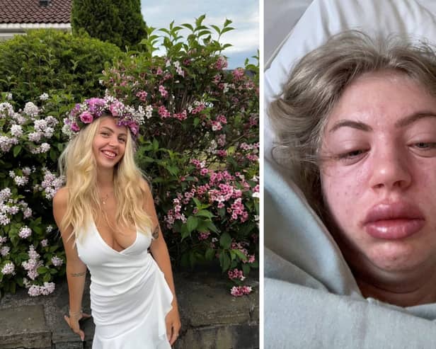 Silje Søndrål Reinertsen has become allergic to "everything" due to a rare condition. (Picture: SWNS)