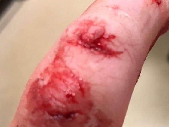 A West Yorkshire police officer had to have tetanus shot and course of antibiotics after being bitten by a man carrying hepatitis C. PIC: PC Morgan Taylor