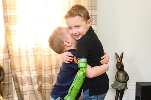 Jacob Scrimshaw, 5, hugging his younger brother Sebastian, 3 with his new prosthetic arm -