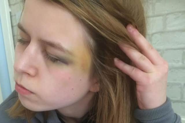 Beth Smith injuries after the assault. (Picture SWNS)