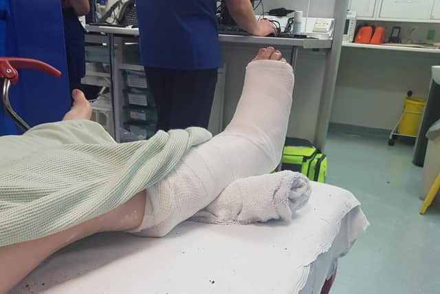 Leg in cast after 20-foot fall