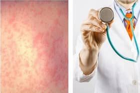 Concerns about a measles outbreak and falling take up for MMR vaccinations were discussed by Calderdale councillors
