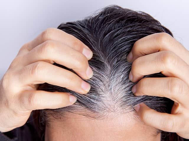 For hair strands to grow grey or white they have to grow out from the root or the follicle. Yet science has now shown that stress can indeed cause the change to be rapid. Photo: AdobeStock