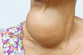 Woman with enlarged hyperthyroid gland. Photo: AdobeStock
