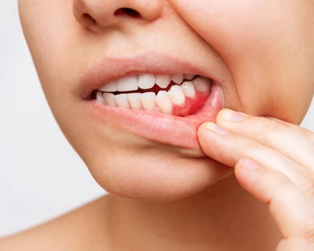 The commonest sign that it is present is soreness in the gums and bleeding when brushing the teeth. Photo: AdobeStock