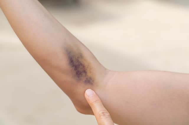 Bruises Blue Raspberry Dr's Casebook: What do the different bruise colours mean?