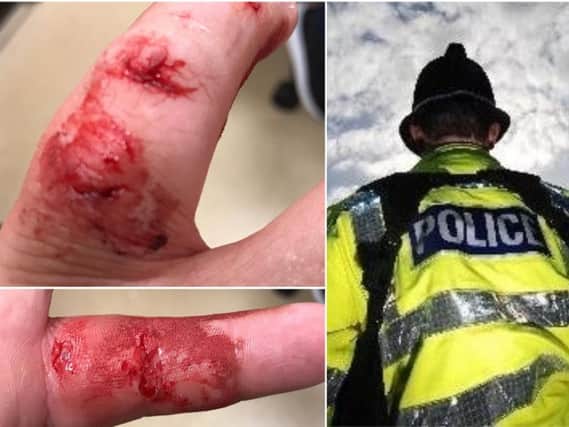 The injures suffered by a Calderdale police officer