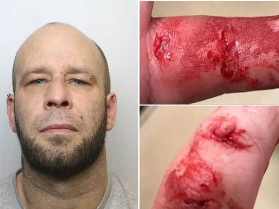 Elland man Daniel Brearley, left, has been jailed after biting a police officer during his arrest. Right, the injuries that the police officer suffered.