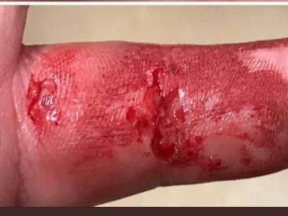 A West Yorkshire police officer had to have tetanus shot and course of antibiotics after being bitten by a man carrying hepatitis C. PIC: PC Morgan Taylor