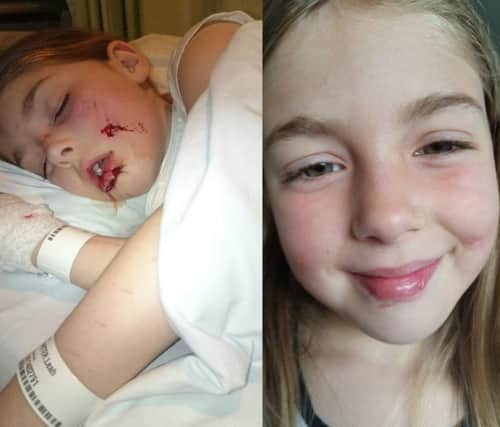 Seven-year-old Leah Carter's injuries shortly after a horrific doorstep dog attack (left) by a Staffordshire Bull Terrier and on her road to recovery (right)