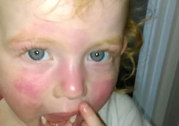 Martha Byrnes face was covered in a painful rash after using the wipes.